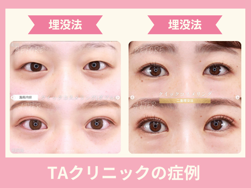 TAクリニック　二重症例写真