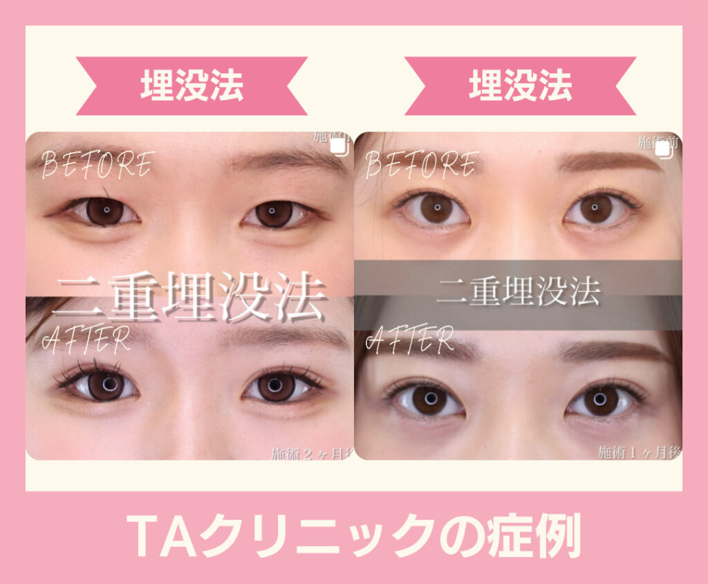 TAクリニック　札幌　二重整形　症例